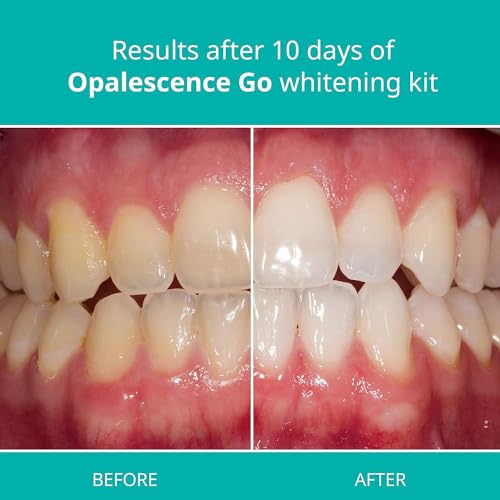 Opalescence Go 15- Prefilled Teeth Whitening Trays - 15% Hydrogen Peroxide - (10 Treatments) Made by Ultradent Products. Teeth Whitening Kit -Mint - 5194-1