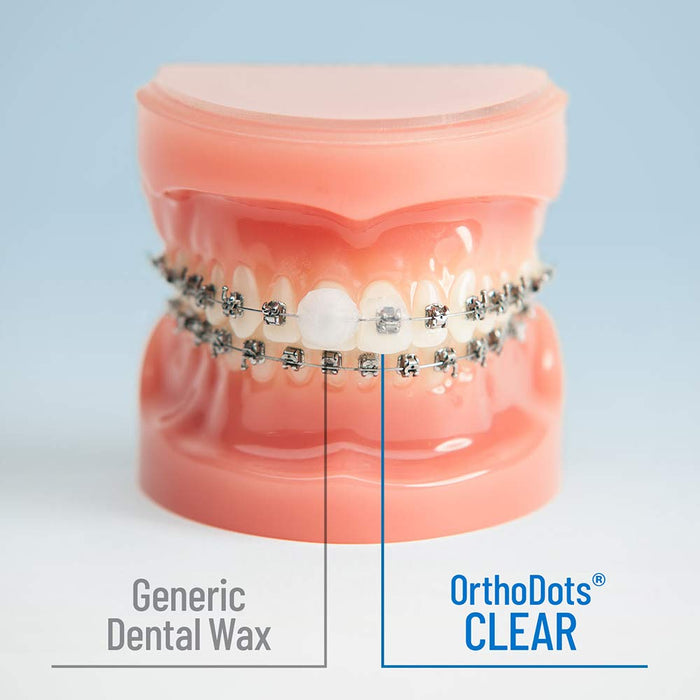 OrthoDots CLEAR – Moisture Activated Braces Wax Alternative for Pain Caused by Braces, Clear Aligner Trays, and Other Orthodontic Appliances. OrthoDots Stick Better and Stay on Longer than Dental Wax.